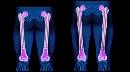 BILATERAL FEMUR LENGTHENING